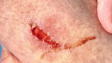Understanding Skin Tears